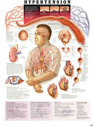 plansze anatomiczne chorób człowieka - Plansza anatomiczna nadcisnienie1.jpg